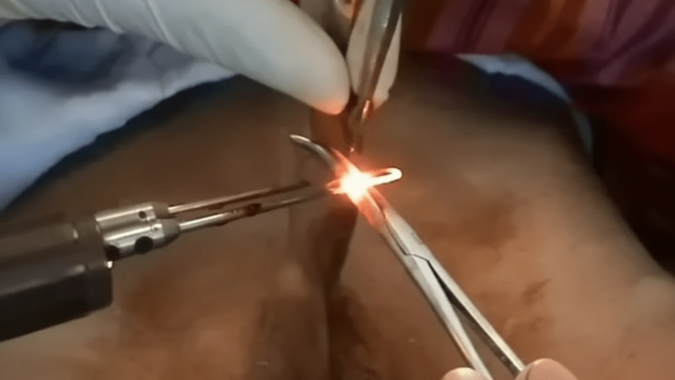 Khitan laser