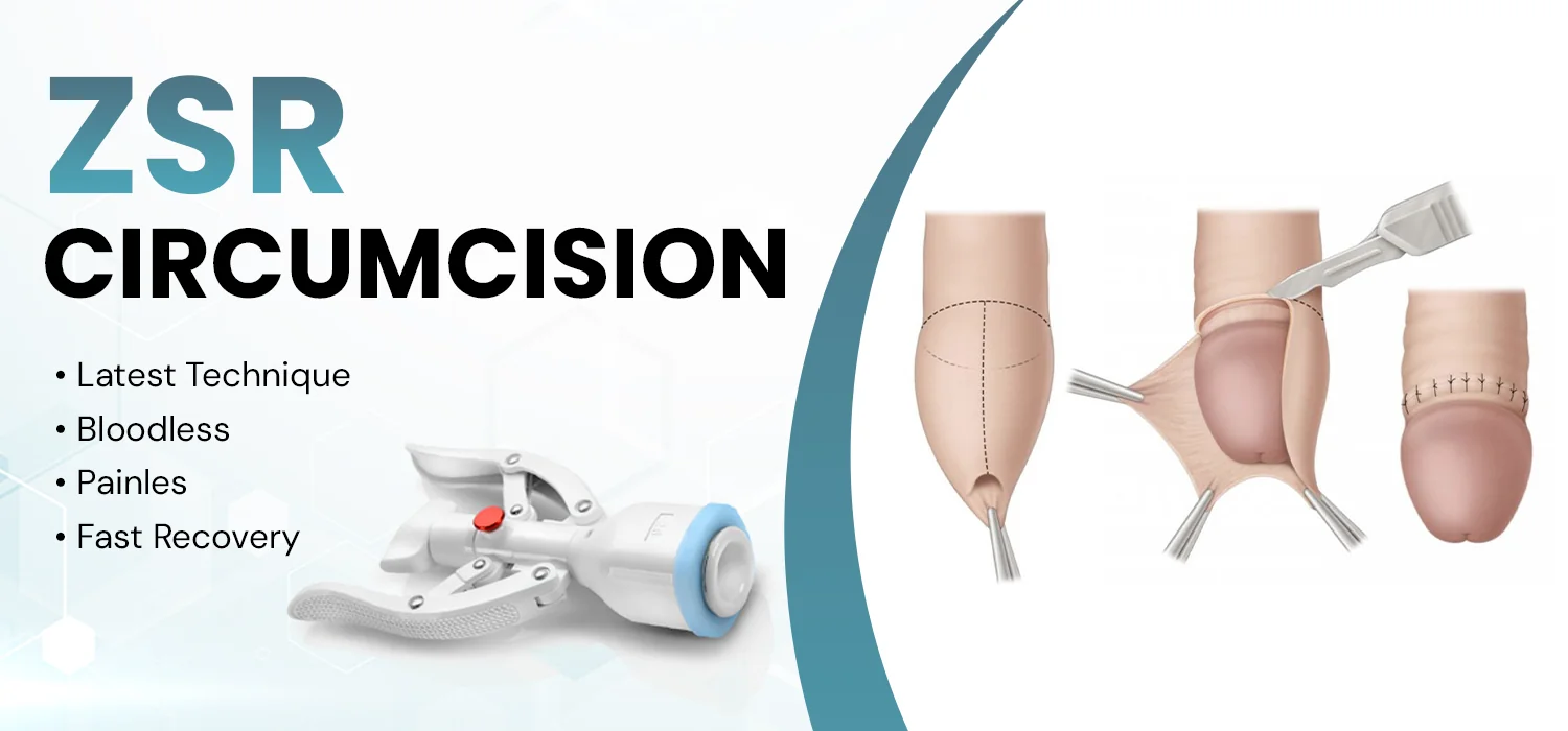 zsr circumcision.png